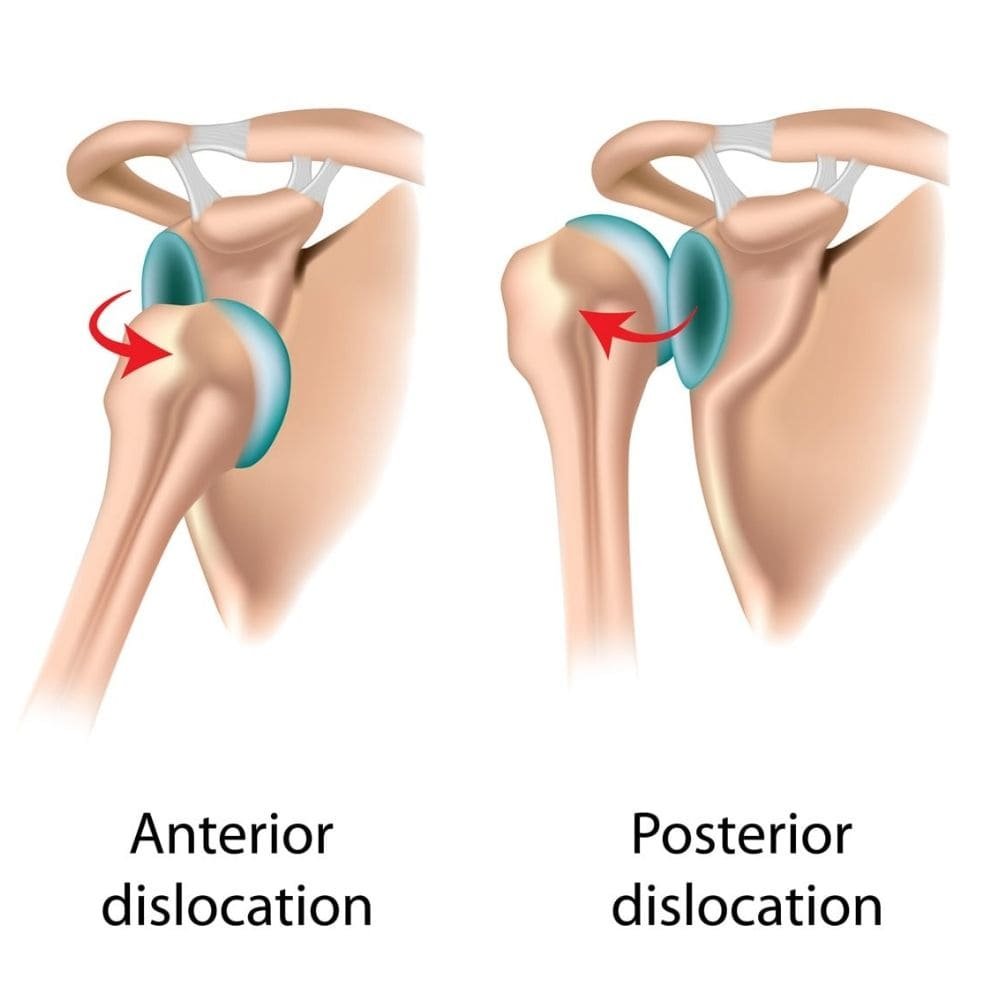 Recurrent Shoulder dislocation 1