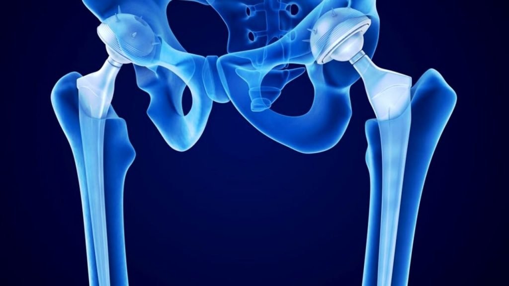 HIP Replacement in Noida